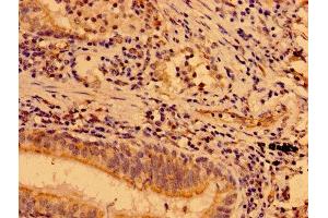 IHC image of ABIN7160061 diluted at 1:400 and staining in paraffin-embedded human lung cancer performed on a Leica BondTM system. (MAP3K9 anticorps  (AA 864-1098))