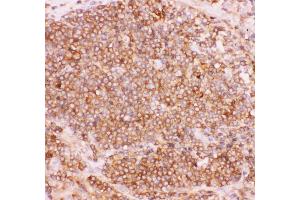 Anti-NFkB p100 Picoband antibody,  IHC(P): Human Lung Cancer Tissue