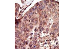 Formalin-fixed and paraffin-embedded human cancer tissue reacted with the primary antibody, which was peroxidase-conjugated to the secondary antibody, followed by AEC staining. (PKLR anticorps  (C-Term))