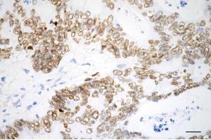 Immunohistochemistry was performed on paraffin-embedded human sigmoid colon carcinoma using SATB2 antibody (ABIN7800274), 1:200).