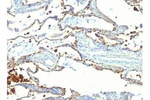 FFPE human lung carcinoma tested with MFG-E8 antibody (SPM291) (MFGE8 anticorps)