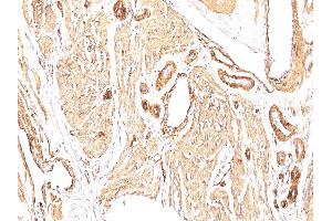 Formalin-fixed, paraffin-embedded human Leiomyosarcoma stained with Smooth Muscle Actin Mouse Monoclonal Antibody (1A4). (Smooth Muscle Actin anticorps  (N-Term))