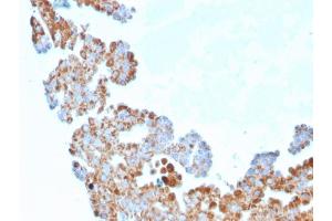 Formalin-fixed, paraffin-embedded human Breast Carcinoma stained with CDC34 Mouse Monoclonal Antibody (CPTC-CDC34-2). (CDC34 anticorps)