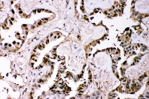 Anti- GST3/GST pi Picoband antibody, IHC(P) IHC(P): Human Lung Cancer Tissue