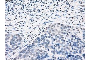 Immunohistochemical staining of paraffin-embedded Adenocarcinoma of colon tissue using anti-PPP5Cmouse monoclonal antibody. (PP5 anticorps)