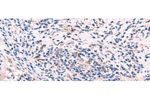 Immunohistochemistry of paraffin-embedded Human cervical cancer tissue using GKAP1 Polyclonal Antibody at dilution of 1:95(x200)