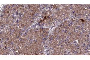 ABIN6277856 at 1/100 staining Human liver cancer tissue by IHC-P. (MAG anticorps  (C-Term))