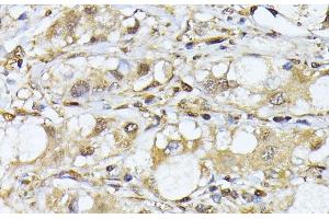 Immunohistochemistry of paraffin-embedded Human liver cancer using PSMA7 Polyclonal Antibody at dilution of 1:100 (40x lens). (PSMA7 anticorps)