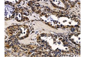 ABIN6257506 and ABIN6274319 at 1/100 staining human ovarian cancer by IHC-P. (SRY anticorps  (Internal Region))