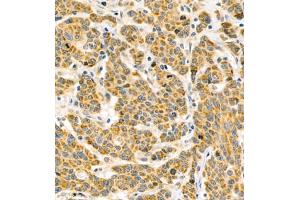 Immunohistochemistry of paraffin embedded human colon cancer using BPTF (ABIN7073234) at dilution of 1:500 (400x lens) (BPTF anticorps)