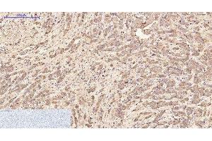 Immunohistochemistry of paraffin-embedded Human breast cancer tissue using AFP Monoclonal Antibody at dilution of 1:200. (alpha Fetoprotein anticorps)