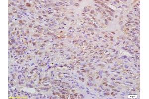 Formalin-fixed and paraffin embedded human cervical carcinoma labeled with Anti-WAPL Polyclonal Antibody, Unconjugated (ABIN872457) at 1:200 followed by conjugation to the secondary antibody (WAPAL anticorps  (AA 731-830))