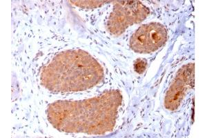 Formalin-fixed, paraffin-embedded human Breast Carcinoma stained with HSP60 Mouse Monoclonal Antibody (CPTC-HSPD1-1). (HSPD1 anticorps)