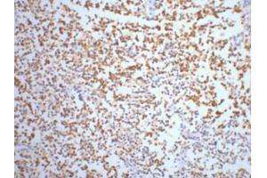 Immunohistochemistry (IHC) staining of Human small cell carcinoma of lung tissue, diluted at 1:200.