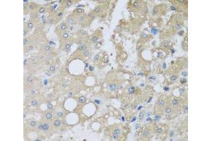 Immunohistochemistry of paraffin-embedded Human liver damage using CHMP1B Polyclonal Antibody at dilution of 1:100 (40x lens). (CHMP1B anticorps)