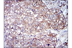 Immunohistochemical analysis of paraffin-embedded lung cancer tissues using NEFL mouse mAb with DAB staining. (NEFL anticorps)