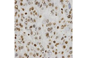 Immunohistochemistry of paraffin-embedded human liver cancer tissue using H3R8me2s antibody at dilution of 1:200 (x400 lens).