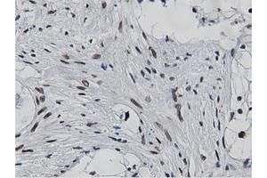 Immunohistochemical staining of paraffin-embedded Carcinoma of Human kidney tissue using anti-NT5DC1 mouse monoclonal antibody. (NT5DC1 anticorps)