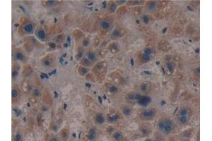 Detection of CS in Human Liver cancer Tissue using Polyclonal Antibody to Citrate Synthase (CS)