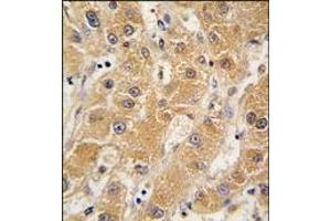 Formalin-fixed and paraffin-embedded human hepatocarcinoma tissue reacted with APOA5 antibody (N-term), which was peroxidase-conjugated to the secondary antibody, followed by DAB staining. (APOA5 anticorps  (N-Term))