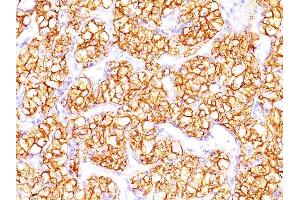 Formalin-fixed, paraffin-embedded human Renal Cell Carcinoma stained with PNA Mouse Monoclonal Antibody (PN-15). (CA9 anticorps)