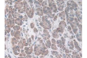 DAB staining on IHC-P; Samples: Human Breast cancer Tissue) (CCL20 anticorps  (AA 27-96))