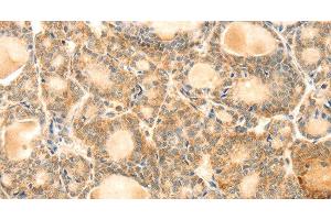Immunohistochemistry of paraffin-embedded Human thyroid cancer using EVA1A Polyclonal Antibody at dilution of 1:30 (TMEM166 anticorps)