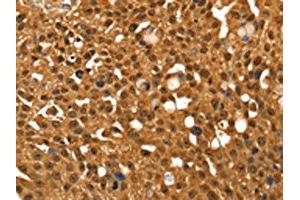 The image on the left is immunohistochemistry of paraffin-embedded Human breast cancer tissue using ABIN7192644(SRGAP1 Antibody) at dilution 1/25, on the right is treated with synthetic peptide.