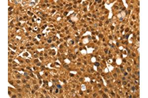 The image on the left is immunohistochemistry of paraffin-embedded Human breast cancer tissue using ABIN7192644(SRGAP1 Antibody) at dilution 1/25, on the right is treated with synthetic peptide. (SRGAP1 anticorps)