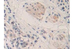 Detection of MMP24 in Human Stomach cancer Tissue using Polyclonal Antibody to Matrix Metalloproteinase 24 (MMP24)