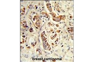Formalin-fixed and paraffin-embedded human breast carcinoma reacted with NCF1C Antibody (C-term), which was peroxidase-conjugated to the secondary antibody, followed by DAB staining. (NCF1C anticorps  (C-Term))