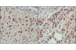 Immunohistochemical analysis of paraffin-embedded human lung cancer (left) and cervical carcinoma (right), showing nuclear localization using ISL1 mouse mAb with DAB staining. (ISL1 anticorps)