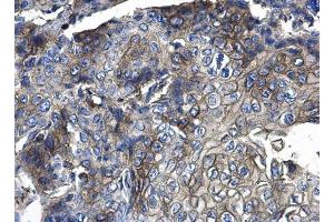 IHC-P Image CD44 antibody detects CD44 protein at membrane and cytoplasm on human endometrial carcinoma by immunohistochemical analysis.