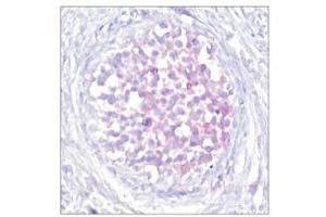 Immunohistochemical analysis of paraffin-embedded human breast carcinoma tissue using Raf-1 (phospho-Ser259) antibody (E011006). (RAF1 anticorps  (pSer259))
