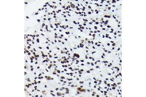 Immunohistochemistry of paraffin-embedded human oophoroma using Phospho-p70 S6 Kinase 1-T421/S424 antibody (ABIN6135340, ABIN6136296, ABIN6136297 and ABIN7101878) at dilution of 1:100 (40x lens).