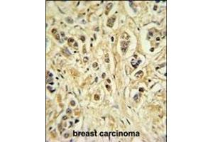ZN Antibody (Center) (ABIN653731 and ABIN2843038) IHC analysis in formalin fixed and paraffin embedded breast carcinoma followed by peroxidase conjugation of the secondary antibody and DAB staining.