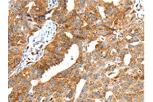 The image on the left is immunohistochemistry of paraffin-embedded Human ovarian cancer tissue using ABIN7192287(SCT Antibody) at dilution 1/40, on the right is treated with synthetic peptide. (Secretin anticorps)