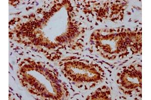 IHC image of ABIN7127740 diluted at 1:100 and staining in paraffin-embedded human breast cancer performed on a Leica BondTM system.