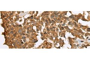 Immunohistochemistry of paraffin-embedded Human ovarian cancer tissue using YBX1 Polyclonal Antibody at dilution of 1:25(x200) (YBX1 anticorps)