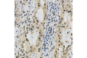 Immunohistochemical analysis of POLR3A staining in human lung cancer formalin fixed paraffin embedded tissue section. (POLR3A anticorps  (N-Term))