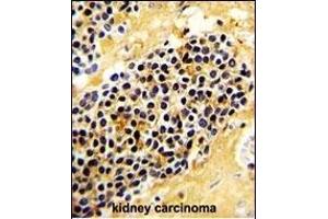 Formalin-fixed and paraffin-embedded human kidney carcinoma with KLRC1 Antibody (C-term), which was peroxidase-conjugated to the secondary antibody, followed by DAB staining.