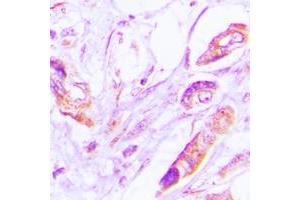 Immunohistochemical analysis of VEGFD staining in human lung cancer formalin fixed paraffin embedded tissue section.