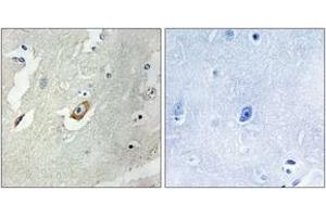 Immunohistochemistry analysis of paraffin-embedded human breast carcinoma tissue, using CDC16/APC6 (Ab-560) Antibody. (CDC16 anticorps  (AA 526-575))