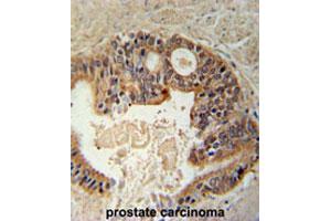 Formalin-fixed and paraffin-embedded human prostate carcinomareacted with DYRK1A polyclonal antibody , which was peroxidase-conjugated to the secondary antibody, followed by AEC staining. (DYRK1A anticorps  (N-Term))