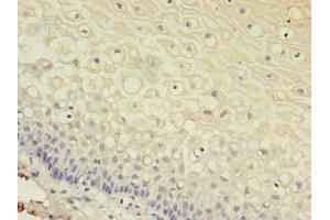 Immunohistochemistry of paraffin-embedded human cervical cancer using ABIN7153613 at dilution of 1:100