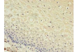 Immunohistochemistry of paraffin-embedded human cervical cancer using ABIN7153613 at dilution of 1:100 (Connexin 31 anticorps  (AA 211-270))