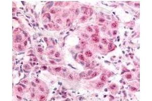 Affinity Purified anti- E2F-1 pS364 antibody was used at a 10 µg/ml to detect nuclear and occasion-ally cytoplasmic signal in a variety of tissues in-cluding multi-human, multi-brain and multi-cancer slides.