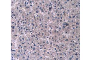 IHC-P analysis of liver cancer tissue, with DAB staining. (PCOLCE anticorps  (AA 315-437))