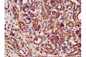 IHC image of ABIN7159577 diluted at 1:400 and staining in paraffin-embedded human pancreatic cancer performed on a Leica BondTM system. (METAP1 anticorps  (AA 54-125))