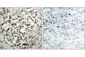 Immunohistochemistry analysis of paraffin-embedded human breast carcinoma, using CREB (Phospho-Ser133) Antibody.